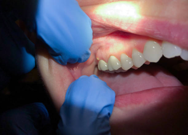 Best Emergency Wisdom Tooth Extraction in Oyster Bay Cove, NY